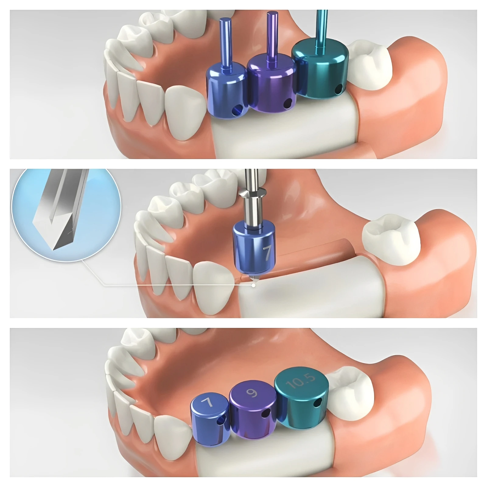 Juego de 19 Piezas de Brocas Guiadas Universales, Kit de Guía y Posicionamiento de Implantes Dentales Universales