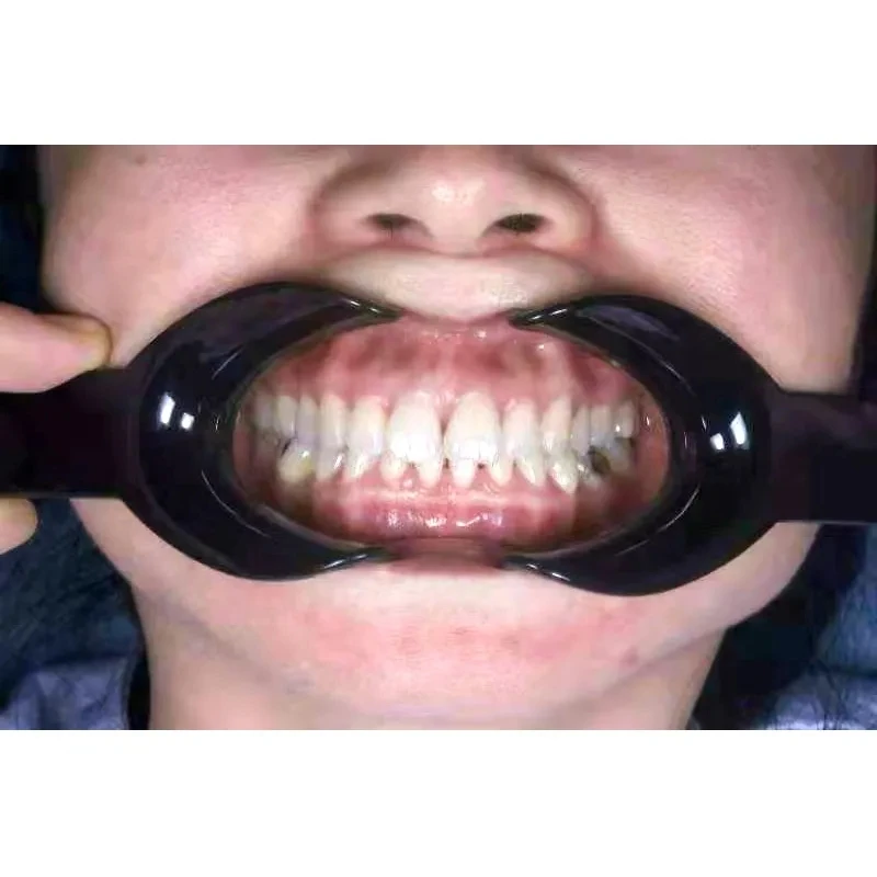 Retractor Dental de labios y mejillas, abridor de boca de doble cabeza, equipo de ortodoncia, limpieza bucal profesional, instrumento de dentista, 2 piezas