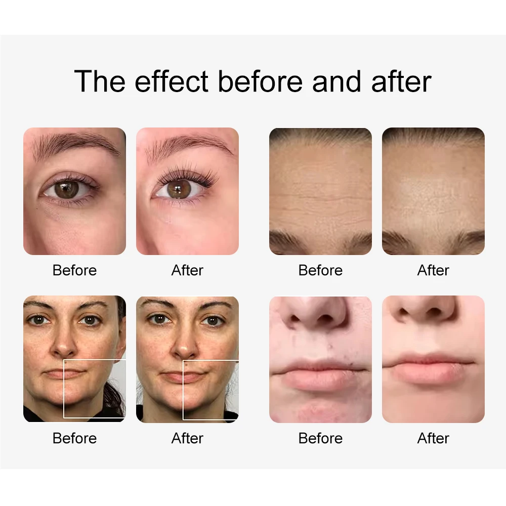 Máquina de Hidrodermoabrasión AOKO 10 en 1, Peeling Acuático, Inyección de Oxígeno, Cuidado Facial por Ultrasonido, Tensado de la Piel, Limpieza Profunda, Dispositivo de Belleza para Eliminar Puntos Negros, Acné y Poros, para Salón y SPA