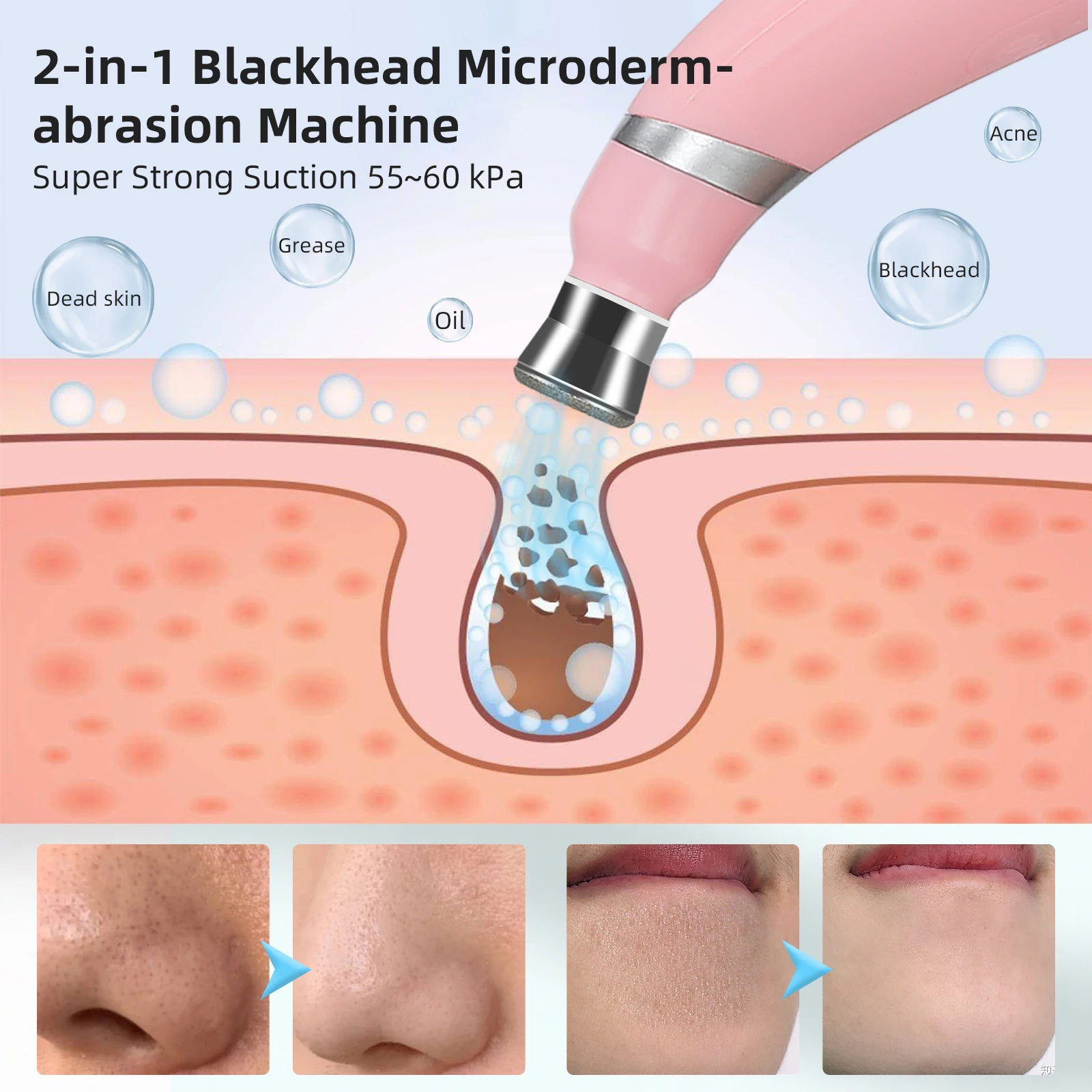 Foreverlily-máquina de pelado de diamante portátil, dispositivo de limpieza Facial de microdermoabrasión, exfoliación, eliminador de espinillas al vacío