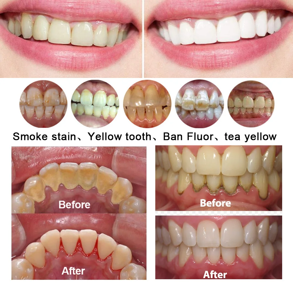 Pulidor Dental de Aire y Agua JUMTOP, Pulverizador de Polvo, Limpieza Bucal, Blanqueamiento Dental, Herramientas de Pulido