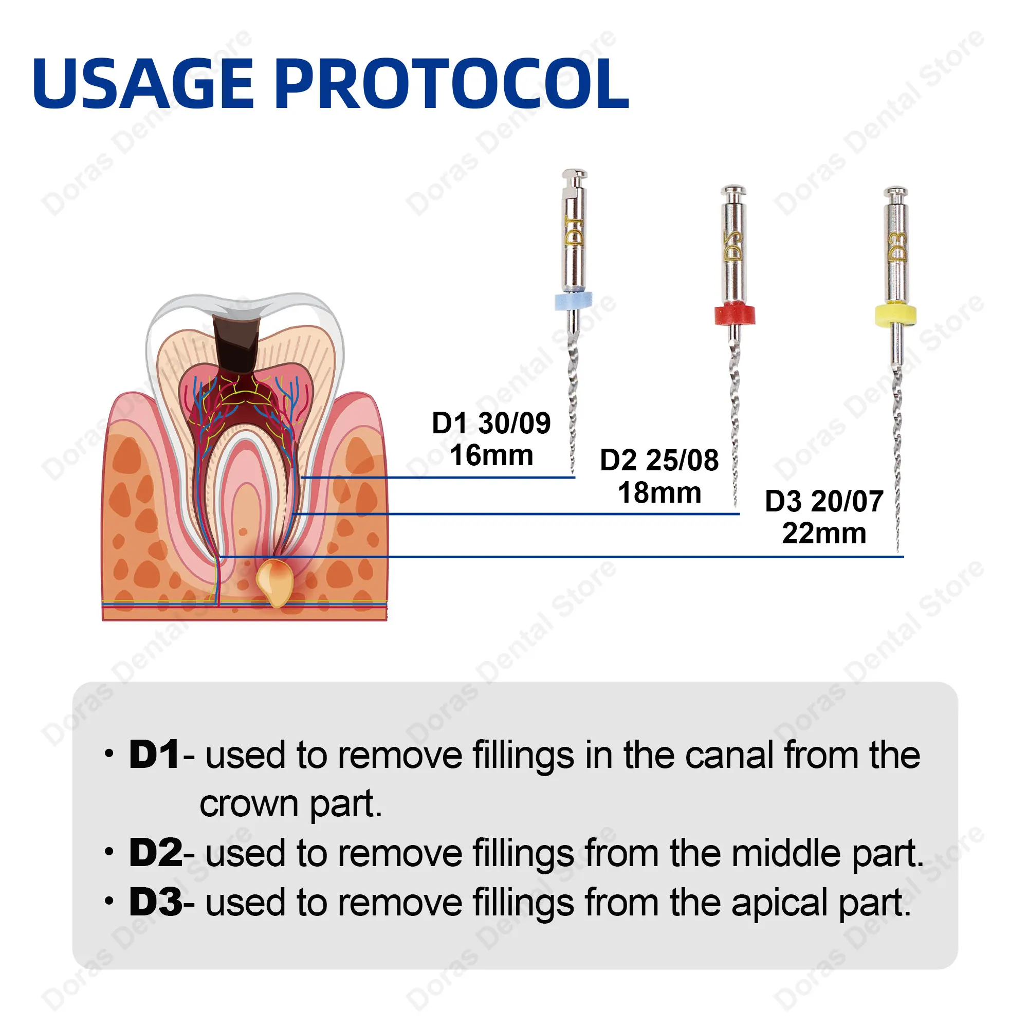 Limas de Retratamiento Glin Dental Super D para Tratamiento de Conducto Radicular, Limas Endodónticas Rotatorias D1-D3, Instrumento de Odontología