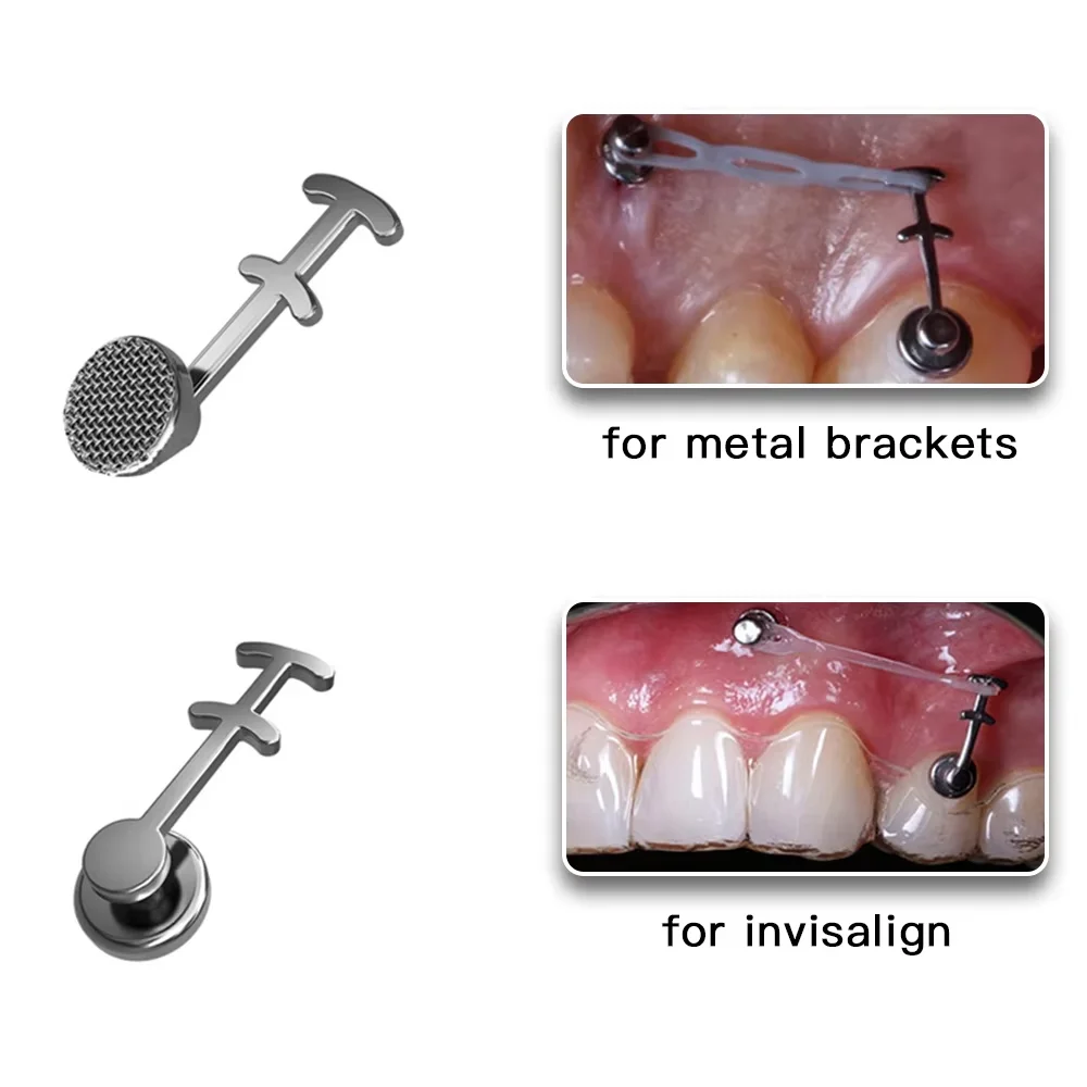 10 unidades de ganchos dentales de ortodoncia crimpables - Botón lingual, ganchos curvos largos con base de malla adherible, derecha/izquierda