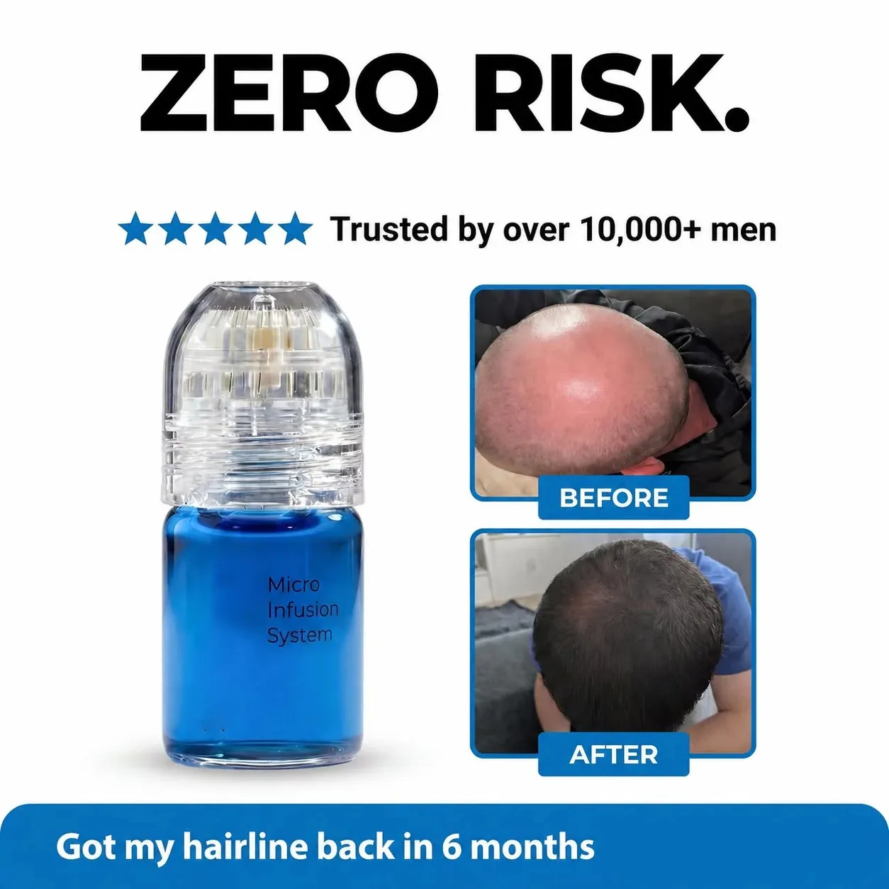 Suero de Crecimiento Capilar con Péptidos de Cobre GHK-Cu, Tratamiento Anticaída del Cabello con Microagujas para Hombres y Mujeres, Cuidado del Cuero Cabelludo