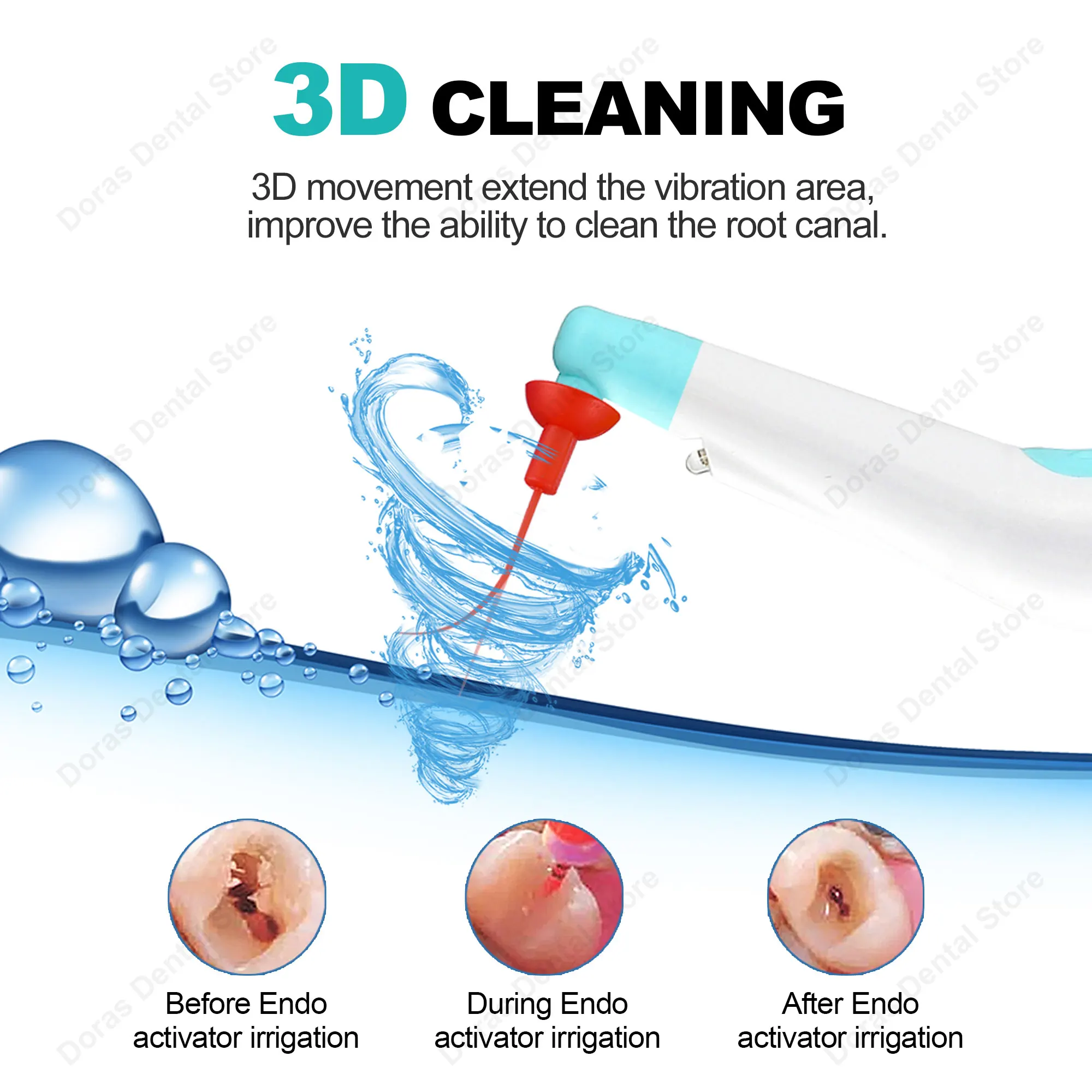 Puntas de irrigador sónico para odontología, puntas de activador sónico endo para instrumento dental, irrigador sónico de conducto radicular endo