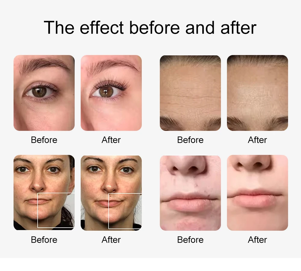 Nuevo equipo facial 10 en 1 para limpieza y cuidado de la piel con oxígeno, hidratante de burbujas y peeling acuático.