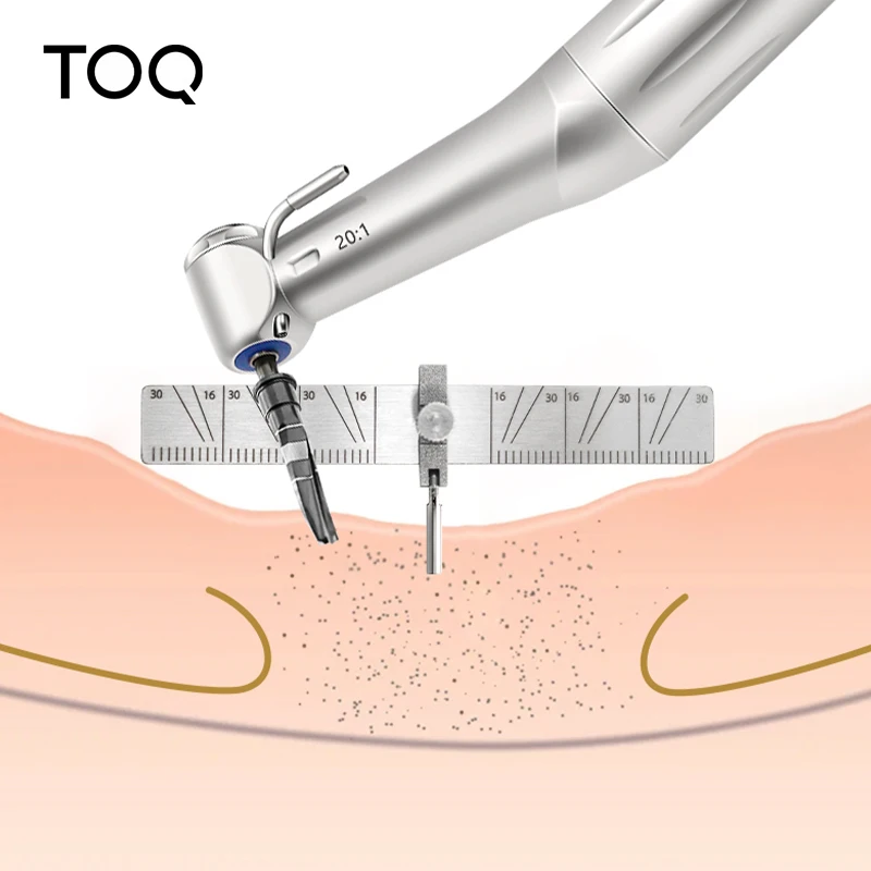 Guía de localización de implantes dentales, localizador de posicionamiento de plantación quirúrgica, regla de ángulo de calibre Autoclavable