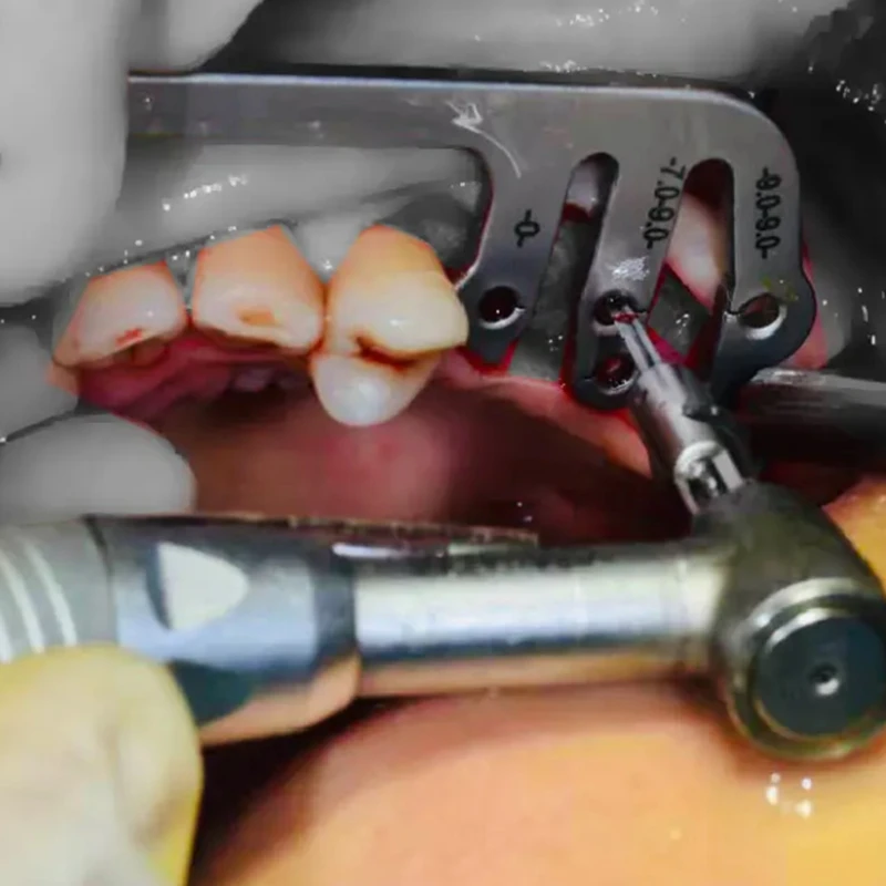 JUMTOP-Juego de guías de implante Dental, localizador de plantación Oral, regla de posicionamiento de perforación, reglas angulares, herramientas de implante de dentista