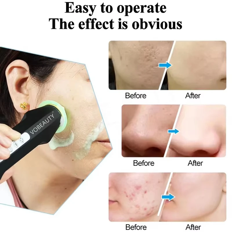 Nuevo diseño, bolígrafo de burbuja de CO2 recargable de mano, cápsulas de oxigenación, cápsulas, máquina Facial de estiramiento de la piel, Kit Facial de oxígeno