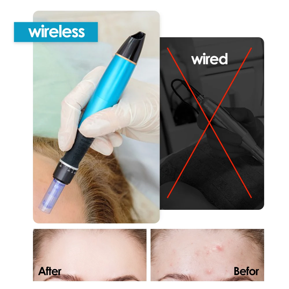 Dr Pen-pluma Derma profesional Ultima A1, microagujas, botón inalámbrico A1, 5 niveles de ajuste, cicatrices, estrías, útil