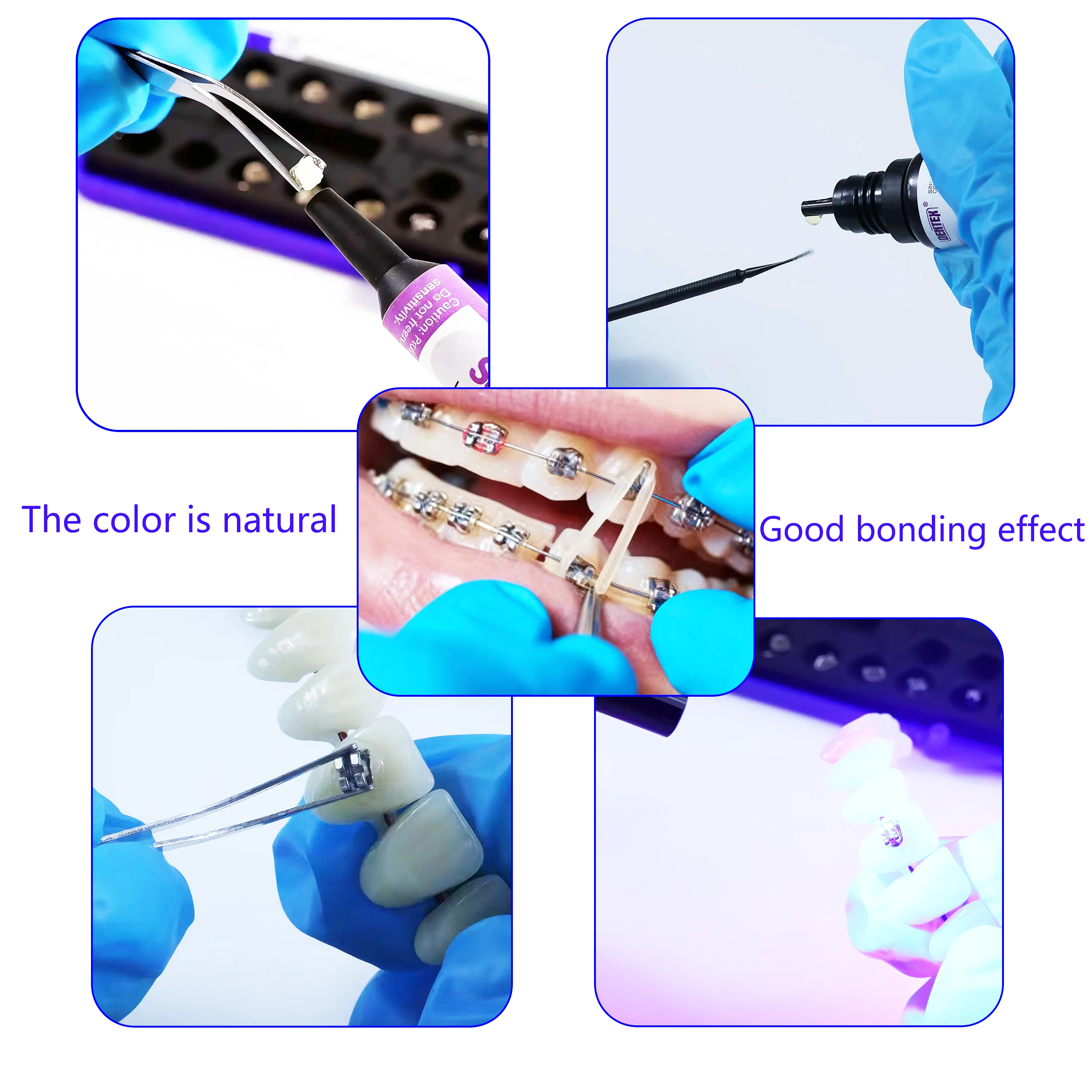 Kit de pegamento de curado ligero adhesivo de ortodoncia Dental, pegamento azul, pasta de pegamento verde, imprimación de grabado, unión Invisible para soportes